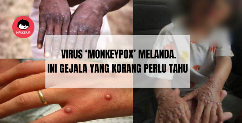 Wabak ‘Monkeypox’ Melanda Dunia, Ini Cara Penularan dan Simptom Kepada Manusia