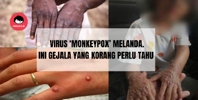 Wabak ‘Monkeypox’ Melanda Dunia, Ini Cara Penularan dan Simptom Kepada Manusia