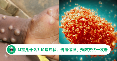 M痘是什么？M痘症状、传播途径、预防方法一次看！